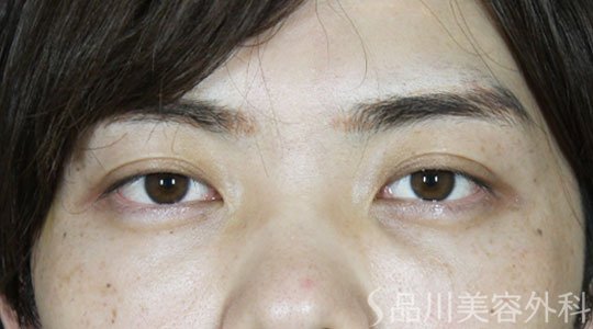 症例NO.62148のBEFORE写真