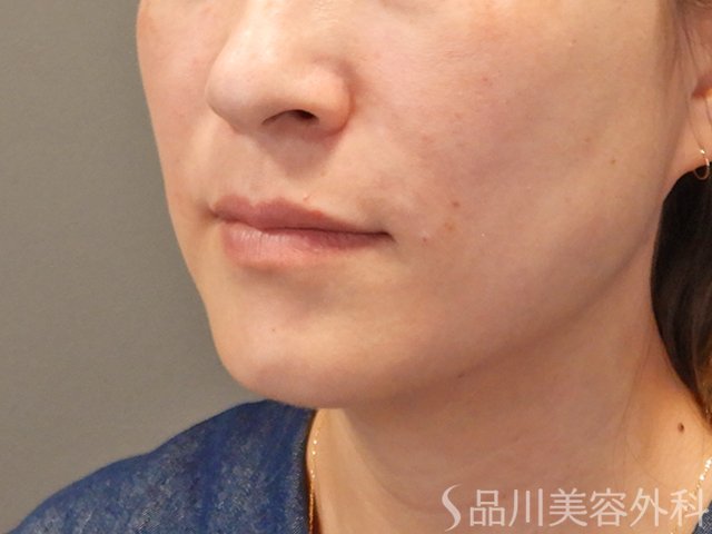 症例NO.74952のAFTER写真
