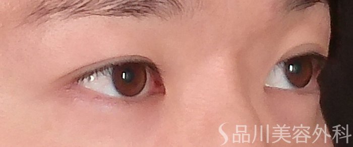症例NO.70869のBEFORE写真