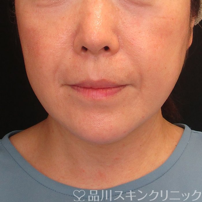 症例NO.73948のBEFORE写真