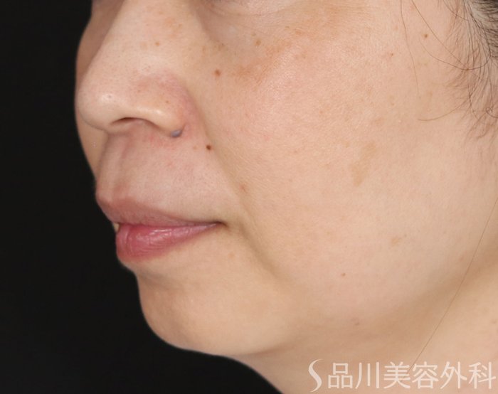 症例NO.72038のBEFORE写真