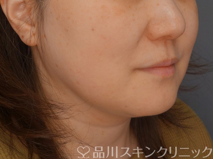 症例NO.72994のBEFORE写真