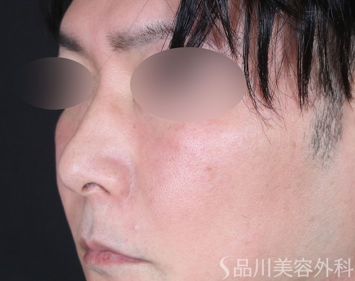 症例NO.72877のBEFORE写真