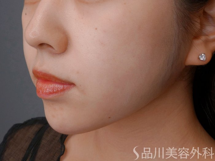 症例NO.73772のAFTER写真