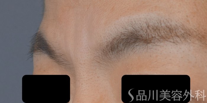 症例NO.72169のAFTER写真