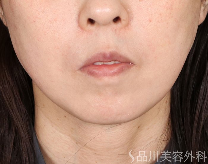 症例NO.71651のAFTER写真