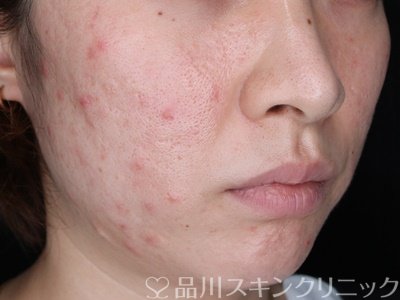 症例NO.74863のBEFORE写真