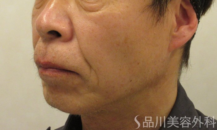 症例NO.73296のBEFORE写真