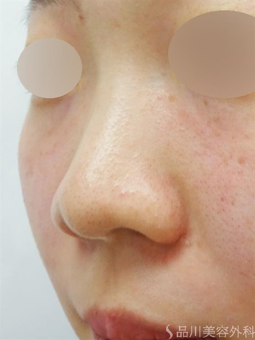 症例NO.39670のBEFORE写真