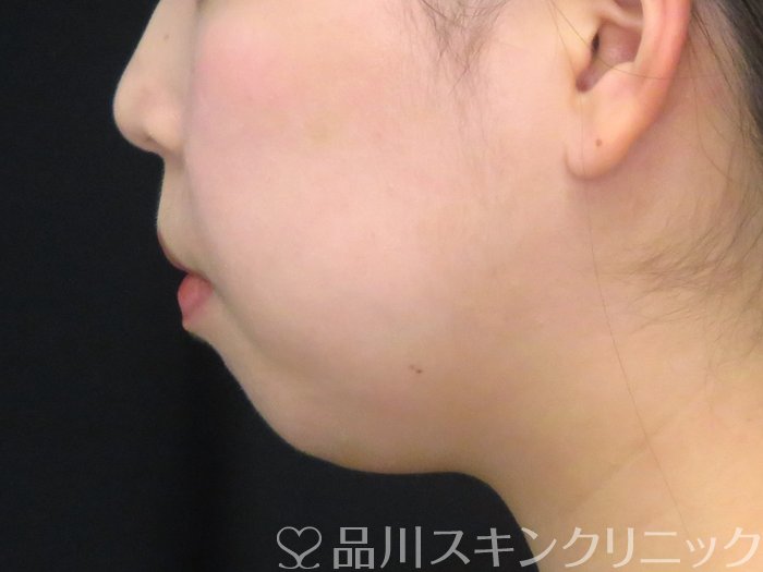 症例NO.67593のBEFORE写真