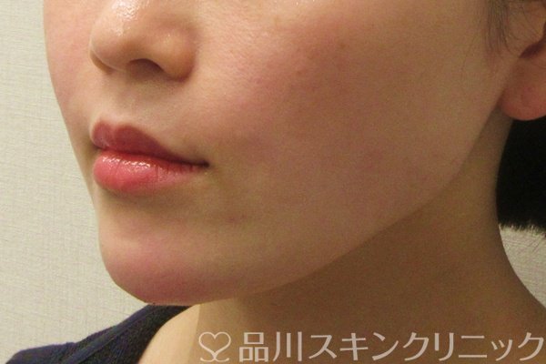 症例NO.75078のAFTER写真