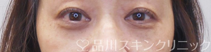 症例NO.70543のAFTER写真