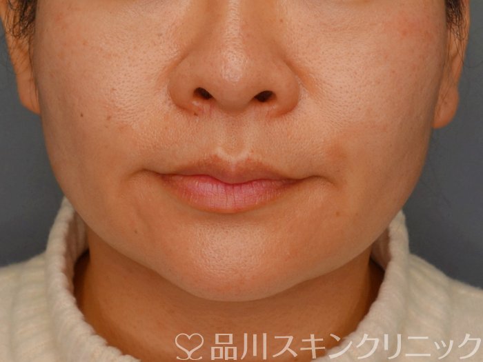症例NO.73773のBEFORE写真