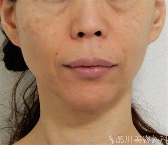 症例NO.39020のBEFORE写真