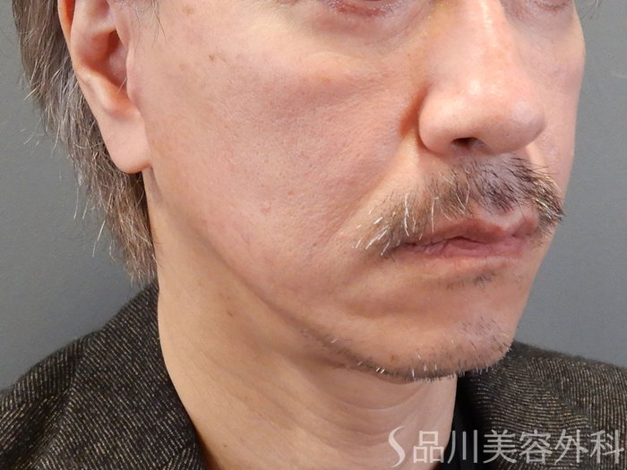 症例NO.70468のAFTER写真