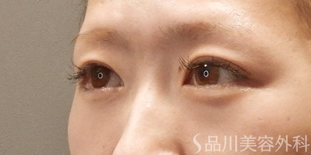 症例NO.74060のAFTER写真