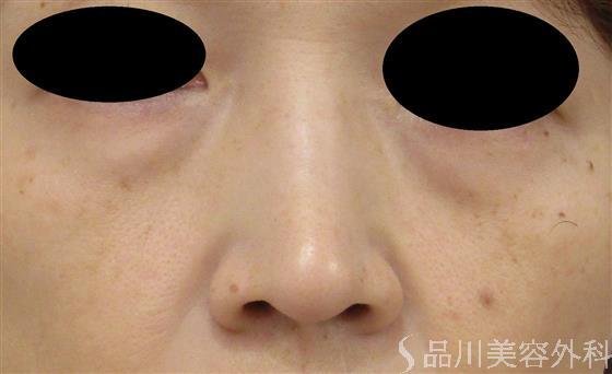 症例NO.45590のBEFORE写真