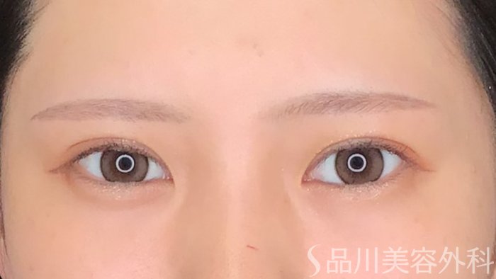 症例NO.62992のAFTER写真