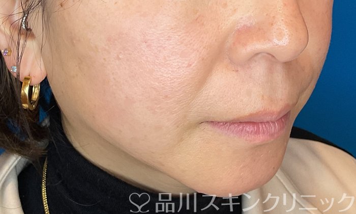 症例NO.74509のAFTER写真