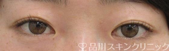 症例NO.33079のBEFORE写真