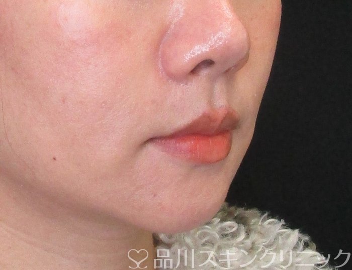 症例NO.73211のBEFORE写真