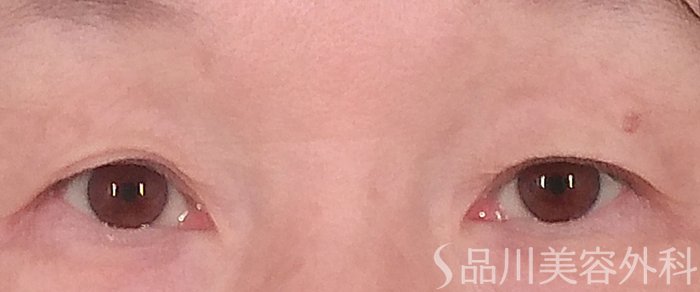症例NO.69375のBEFORE写真
