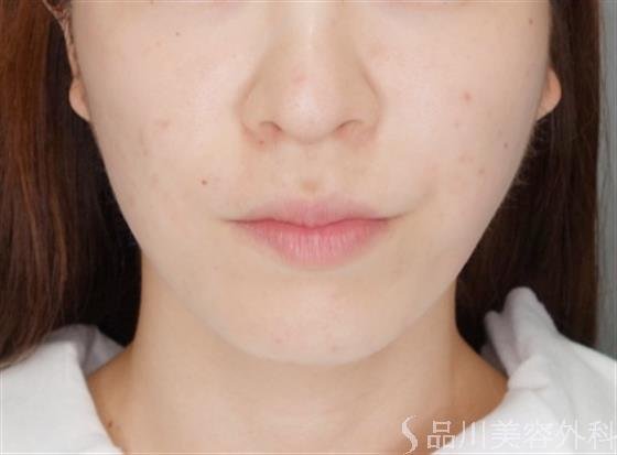 症例NO.53317のAFTER写真