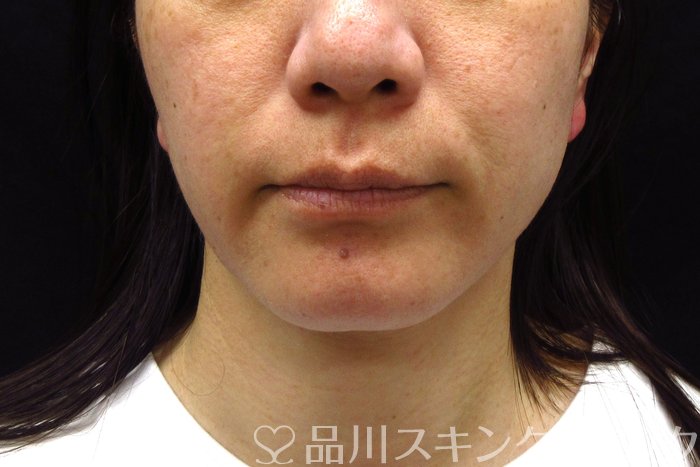 症例NO.74816のBEFORE写真