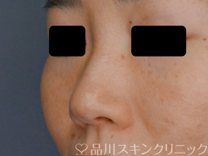 症例NO.71574のBEFORE写真