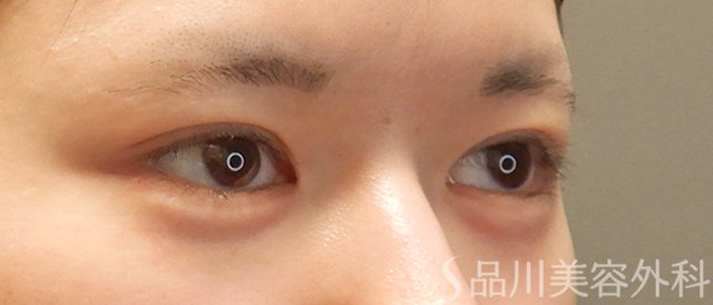 症例NO.73254のAFTER写真