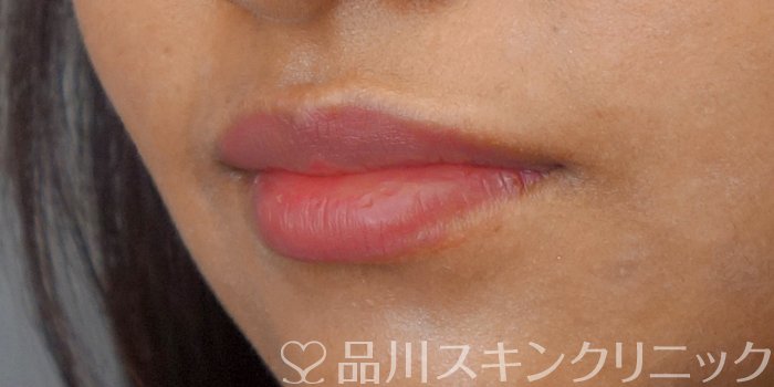 症例NO.72221のAFTER写真