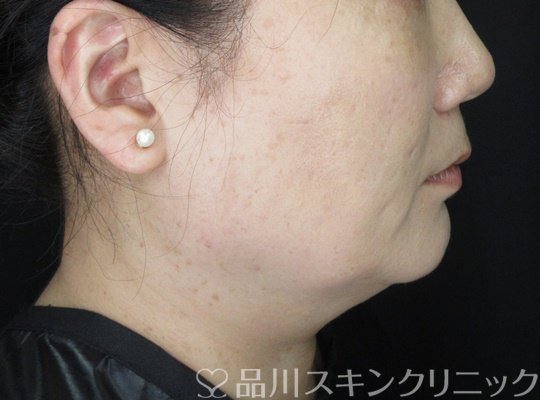 症例NO.70217のAFTER写真