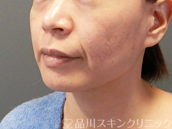 症例NO.63591のBEFORE写真