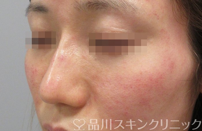 症例NO.70185のAFTER写真