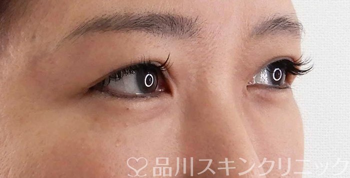症例NO.62183のBEFORE写真