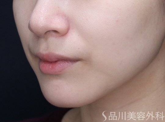 症例NO.73825のBEFORE写真
