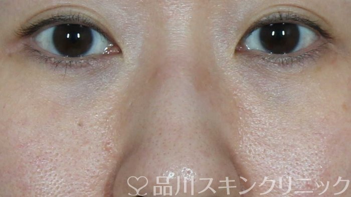 症例NO.71818のAFTER写真