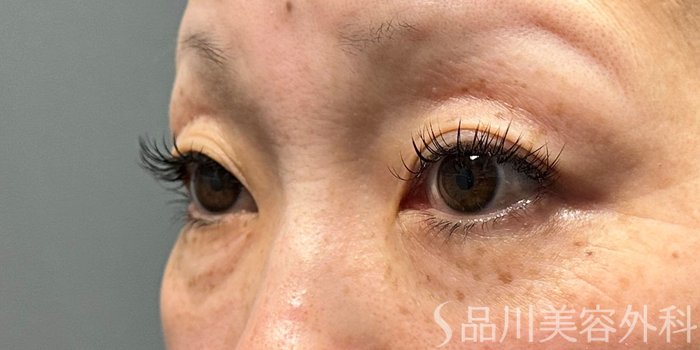 症例NO.70181のBEFORE写真