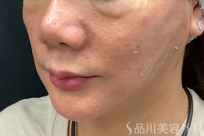 症例NO.67810のAFTER写真