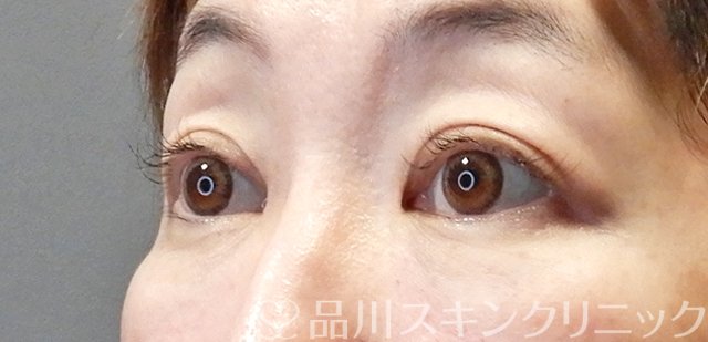 症例NO.67658のAFTER写真