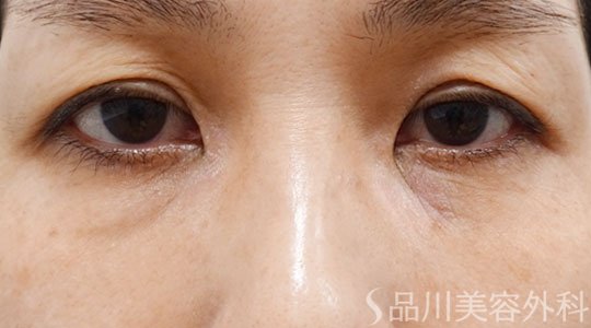 症例NO.74347のBEFORE写真