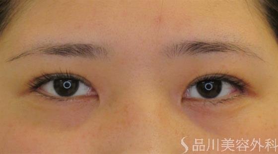 症例NO.48409のAFTER写真