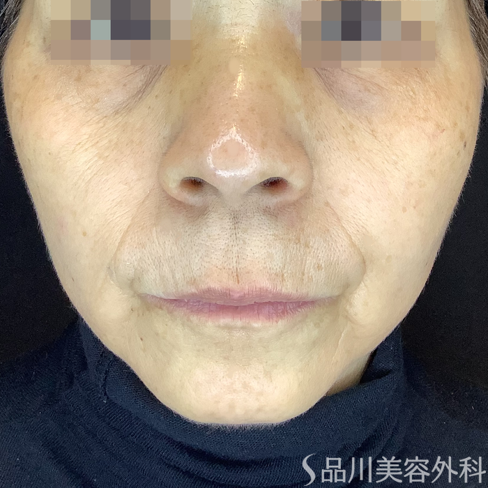 症例NO.62046のAFTER写真