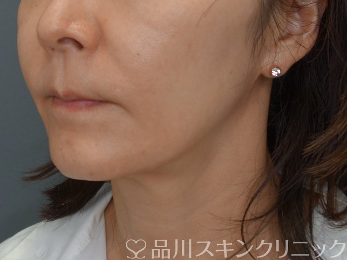 症例NO.71752のBEFORE写真