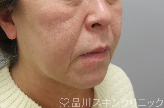 症例NO.69824のBEFORE写真