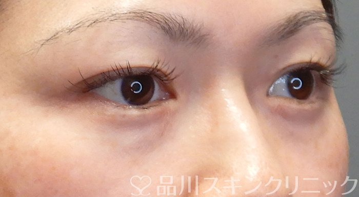 症例NO.69558のAFTER写真