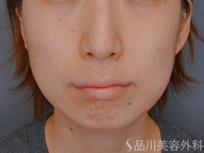 症例NO.73636のBEFORE写真