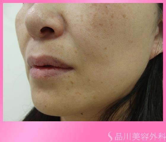 症例NO.4064のBEFORE写真