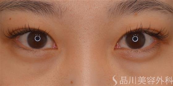 症例NO.60833のBEFORE写真