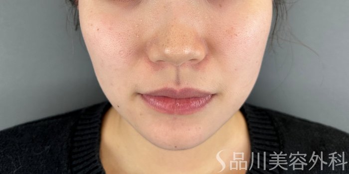 症例NO.65589のBEFORE写真